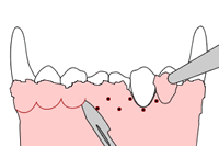 Gingivectomy 2